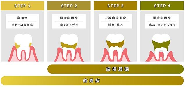 ■歯周病は、若い頃から始まっていることをご存知ですか？