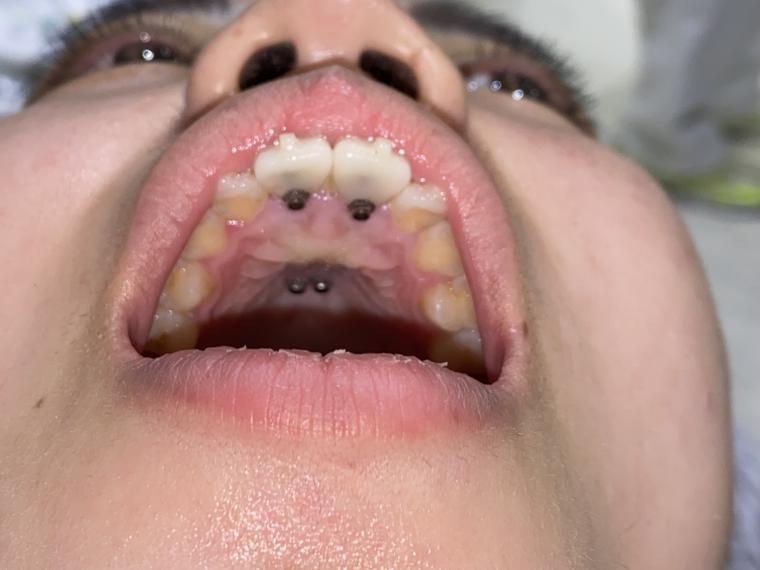 歯を抜かないインビザライン矯正治療マウスピース矯正治療のメリット！