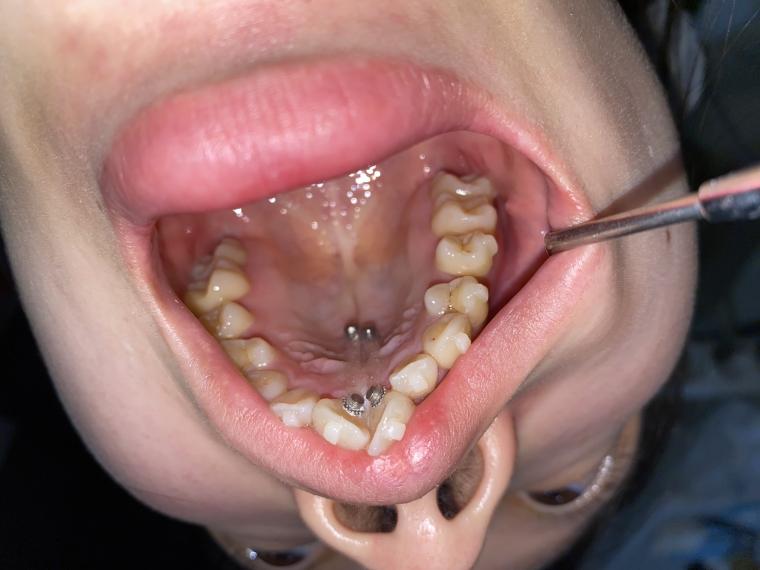 歯を抜かないインビザライン矯正治療マウスピース矯正治療のメリット！
