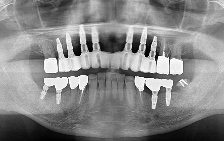 インプラント治療７本＋歯周再生治療（エムドゲイン）