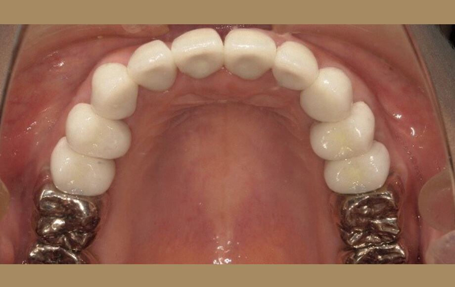 インビザライン矯正歯科治療＋インプラント１本＋上顎オールセラミック