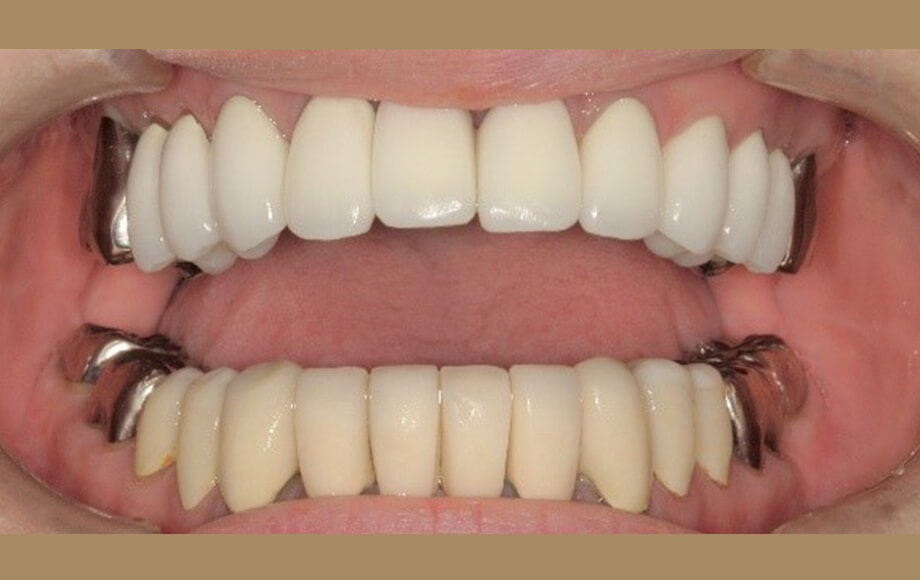 インビザライン矯正歯科治療＋インプラント１本＋上顎オールセラミック