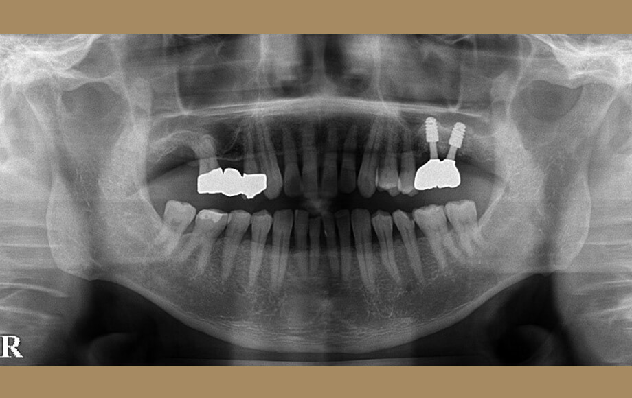 インプラント　2本