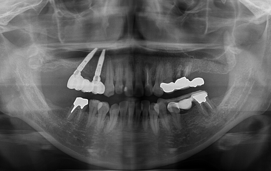 インプラント治療２本　かぶせ物3本