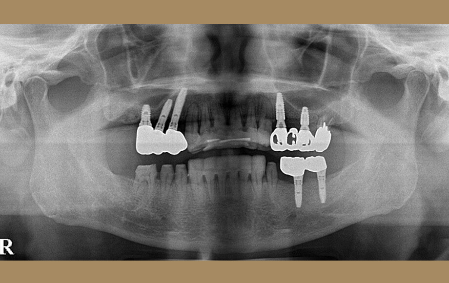 インプラント治療　7本