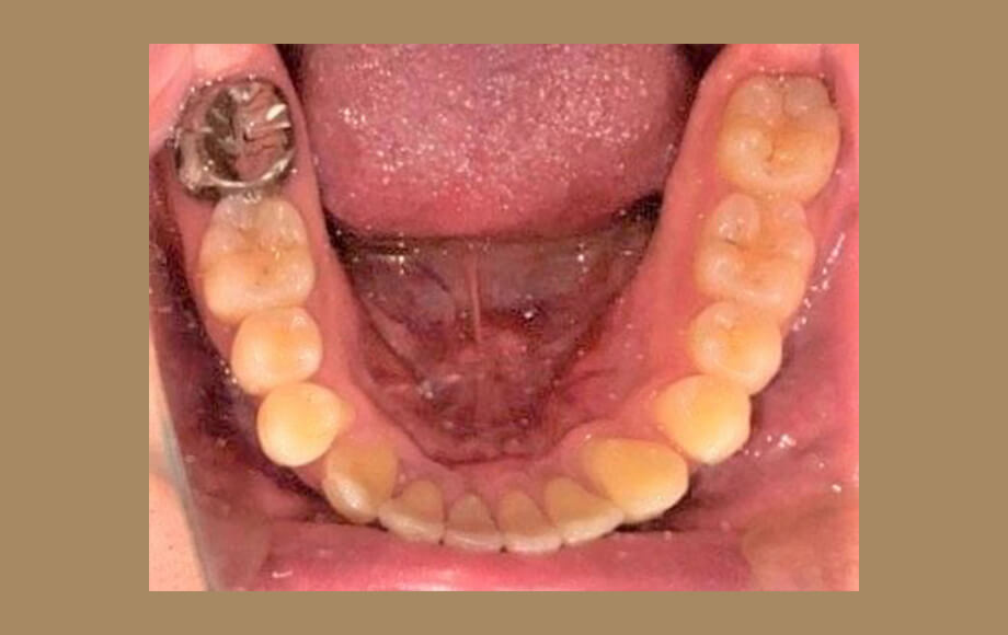 歯を抜かない（非抜歯）インビザライン矯正治療