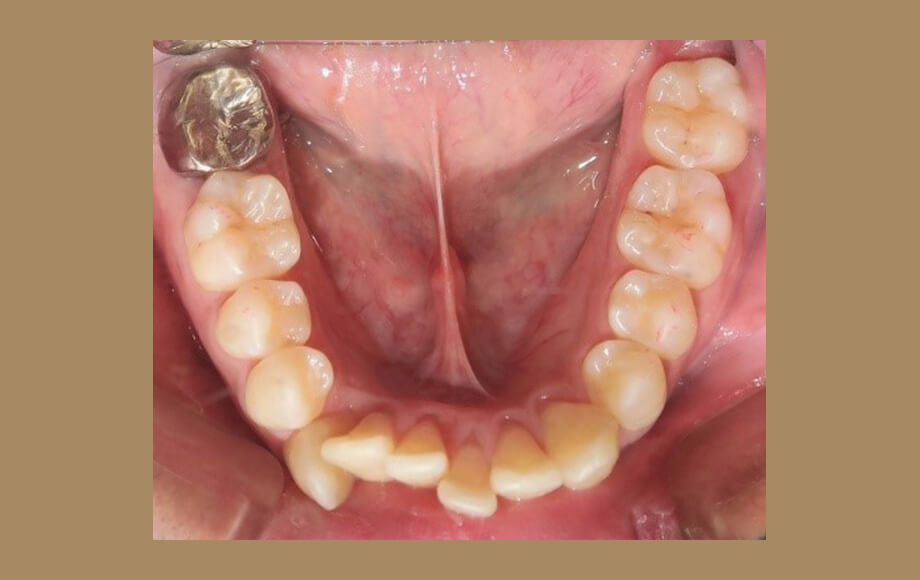 歯を抜かない（非抜歯）インビザライン矯正歯科治療