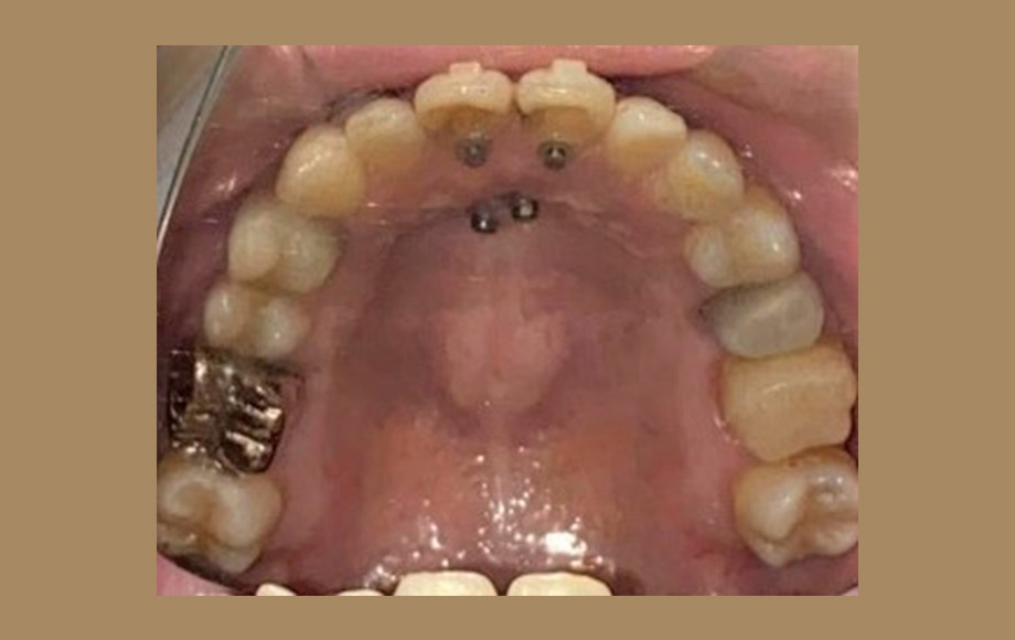 歯を抜かない(非抜歯)インビザライン矯正治療
