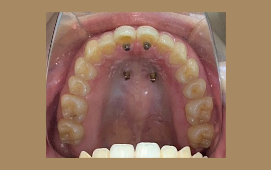 歯を抜かない(非抜歯)インビザライン矯正歯科治療