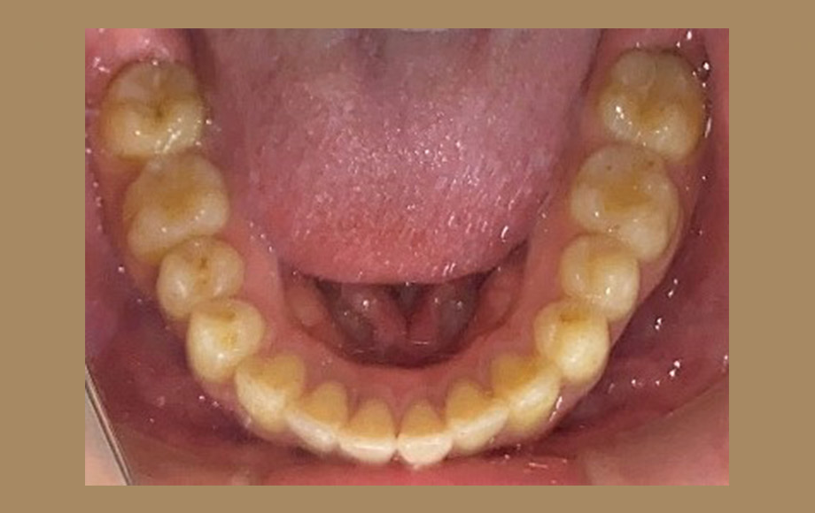 歯を抜かない(非抜歯)インビザライン矯正治療