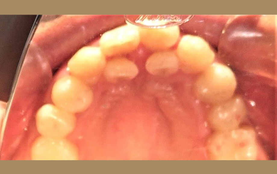 インビザライン矯正歯科治療