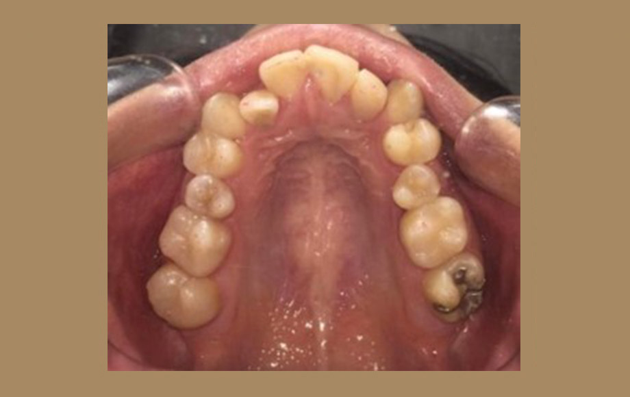 歯を抜かない(非抜歯)インビザライン矯正歯科治療