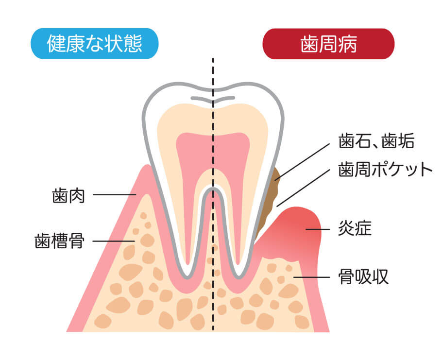 歯周病とは