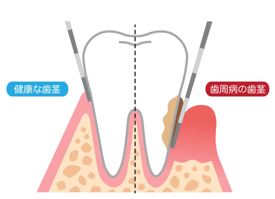 歯周病の検査・診断