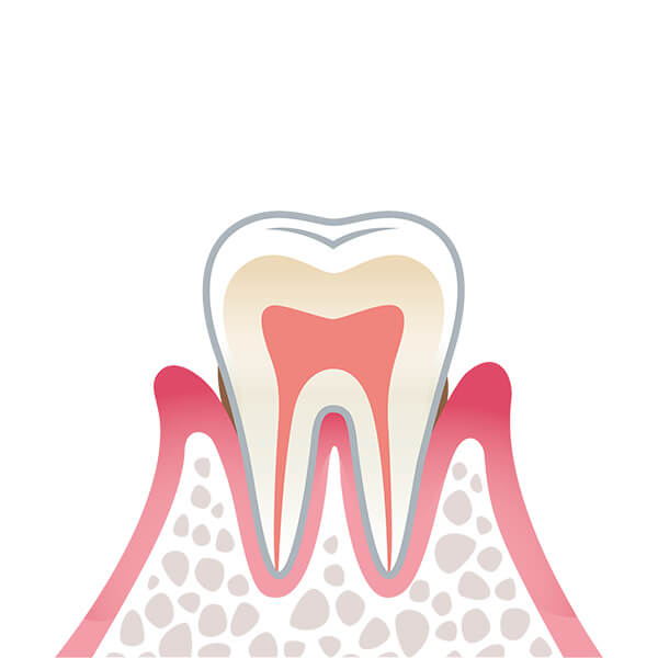 01. 歯肉炎