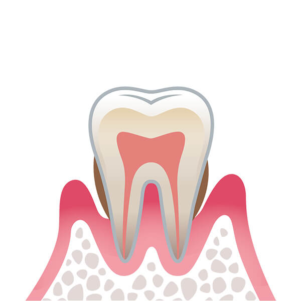 02. 歯周炎