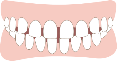 空隙歯列